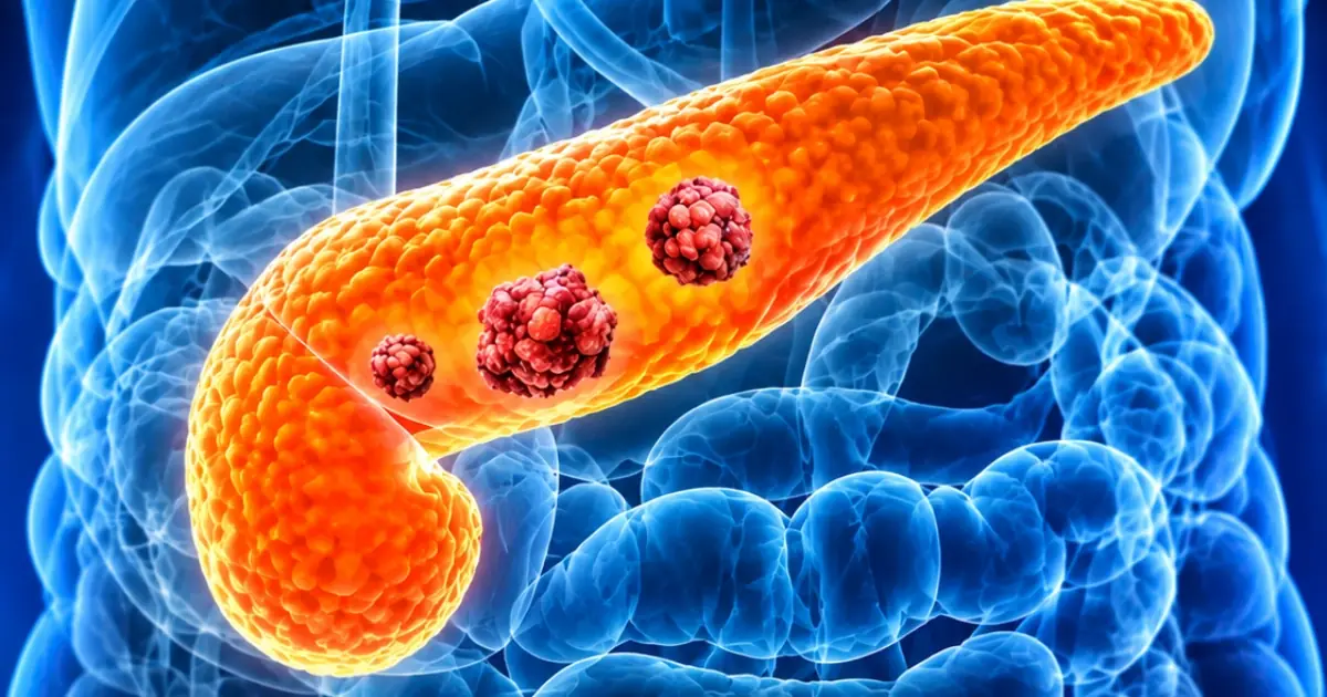 10 Signs of Pancreatic Can.cer You Should Never Ignore