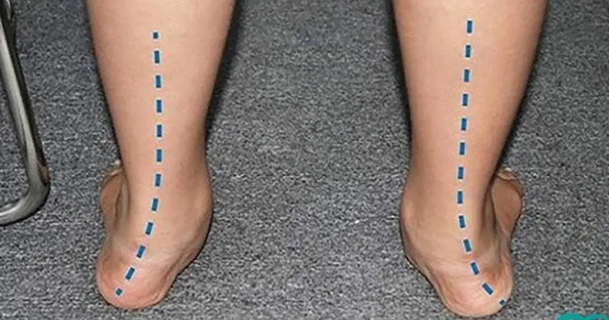 Is It Normal for Chi.ldren to Have Flat Feet? What Parents Need to Know