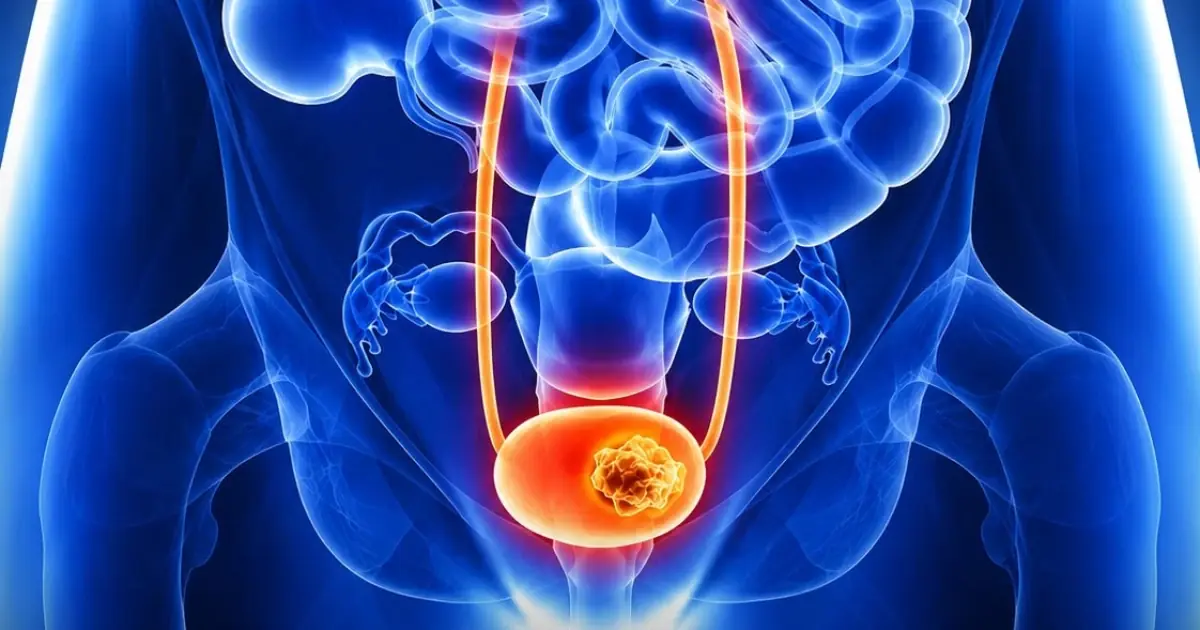 Bladder Cancer Is a Silent Killer: 10 Signs to Spot Early