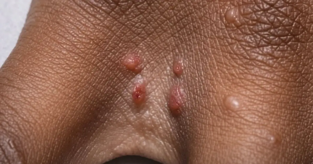 Don't ignore these small red bumps—they could be your body's early warning signal.