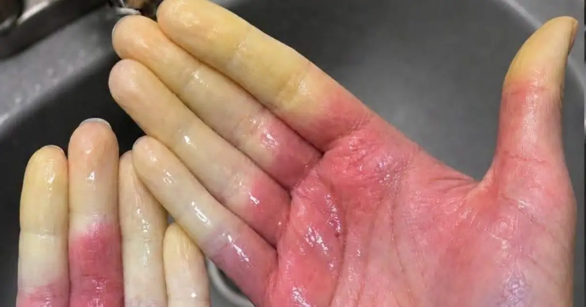 Fingers Turning White, Blue, or Red? Here’s What Your Body May Be Telling You