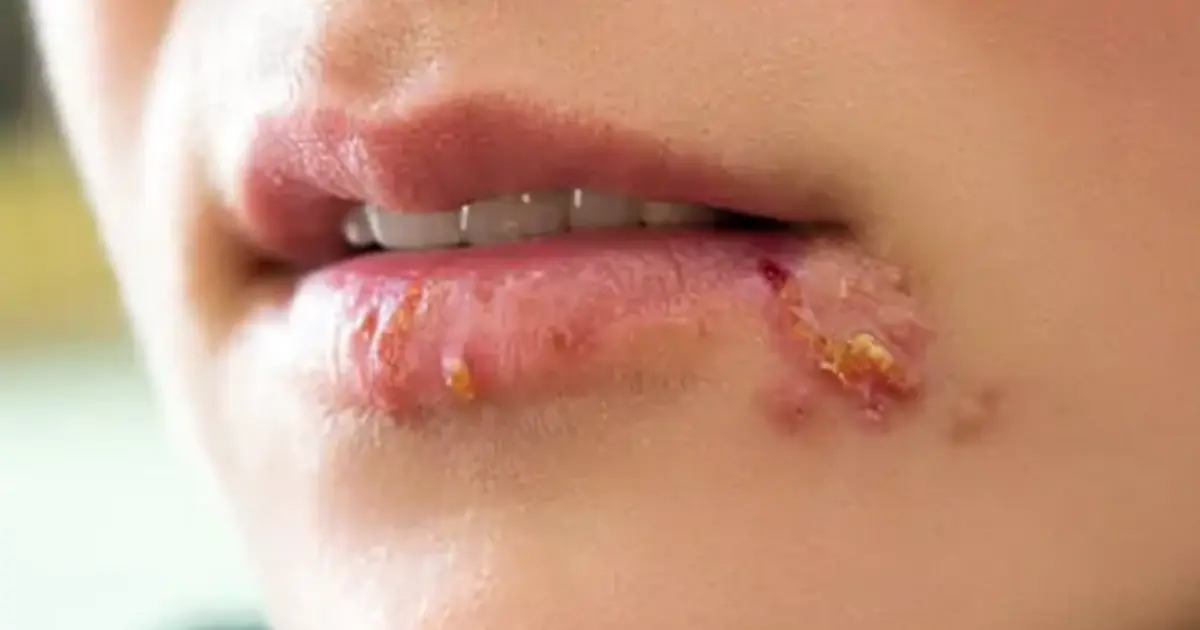 Your Lips May Be Telling You Something - Don’t Ignore These Signs