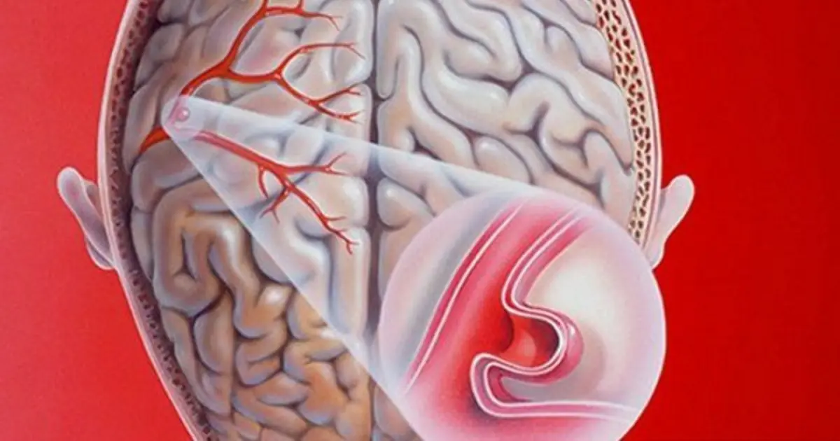 10 Possible Signs of a Brain Aneurysm You Need to Be Aware Of