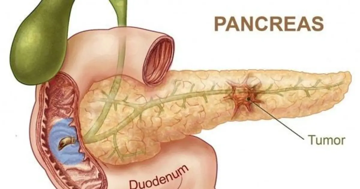 Pancreatic Can.cer: 10 Possible Warning Signs You Shouldn’t Overlook