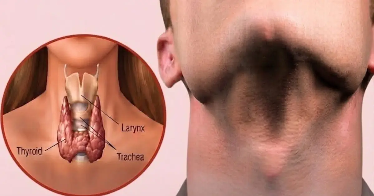 Avoid These 6 Foods That Can Harm Your Thyroid Health