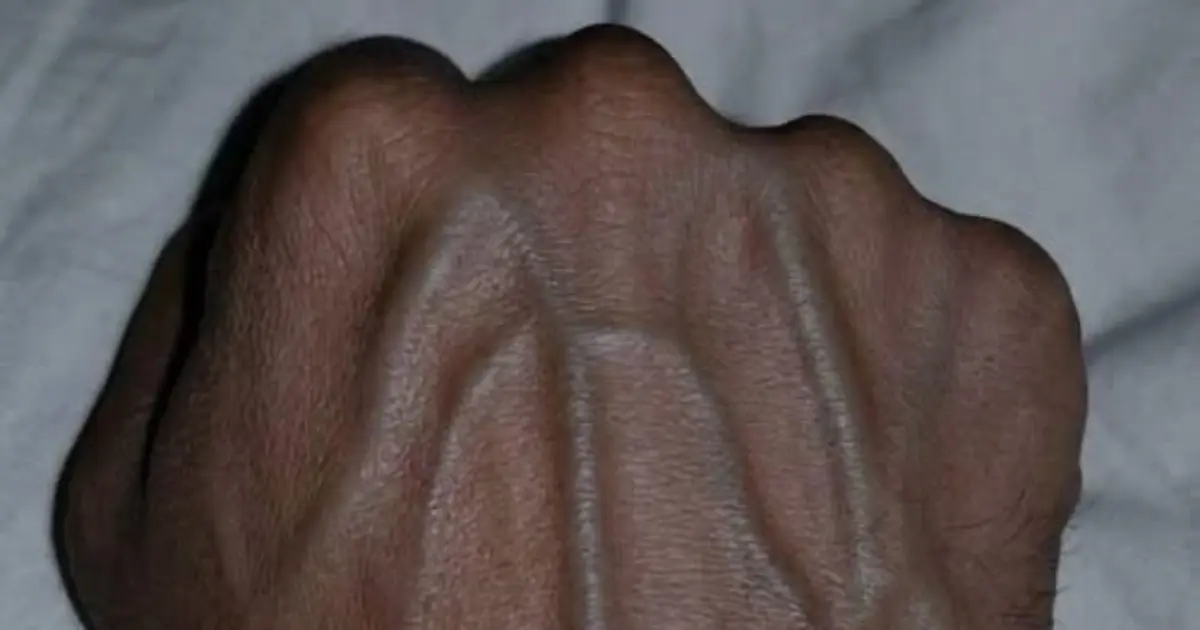 If your veins are visible in your hand, it is a signal of ca… 😳👇