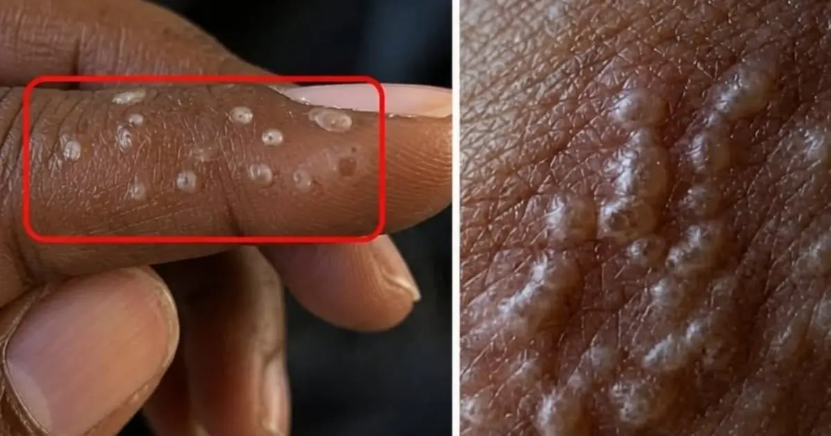 Small Bumps on Your Fingers: Possible Causes and When to See a Doctor