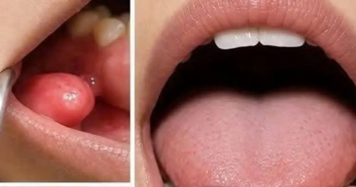 Early Signs of Oral Cancer: Symptoms You Should Know and Never Ignore