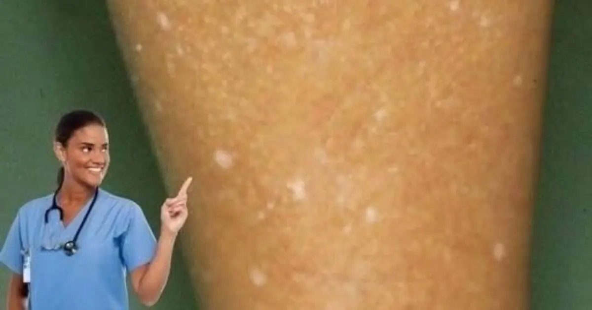 White spots on the skin: Which vitamin deficiencies could be the cause?
