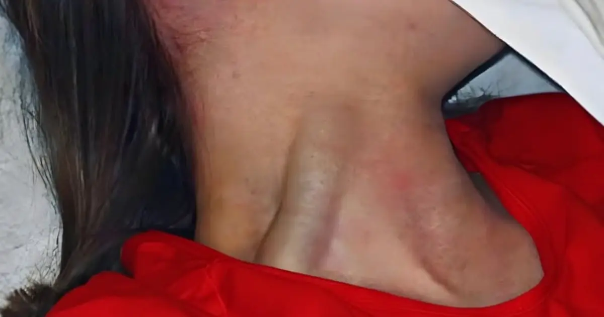 Have You Noticed Bulging Veins in Your Neck? It Could Be Worth Paying Attention