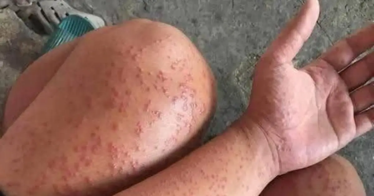 Skin Rash With Breathing Trouble? It Could Be a Life-Threatening Allergic Reaction