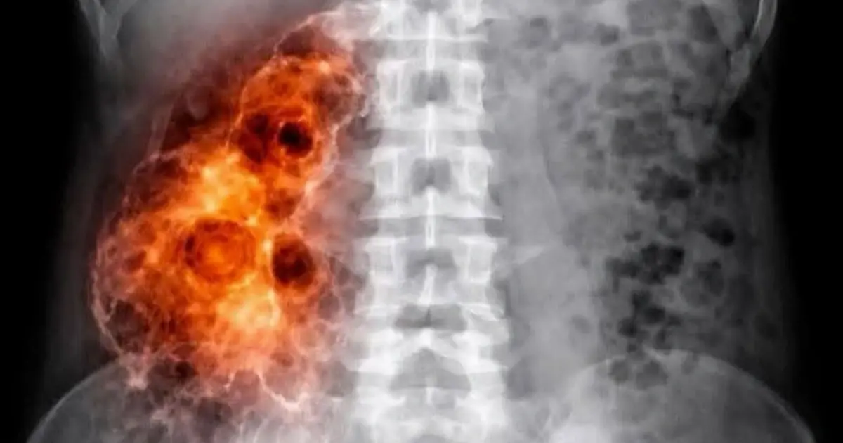 Kidney Inflammation After COVID-19 Vaccination: Warning Signs You Should Know
