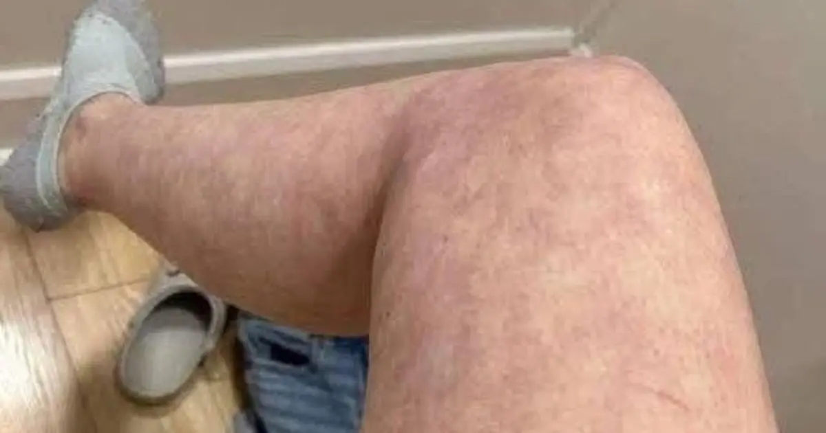 Purple Marks on the Legs: What Could They Mean, and When Should You Worry?