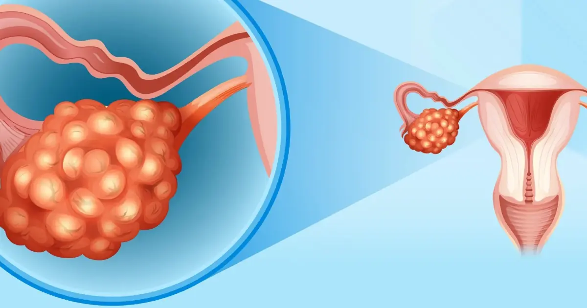 Women: Don't Ignore These 5 Possible Warning Signs of Cer.vical Can.cer