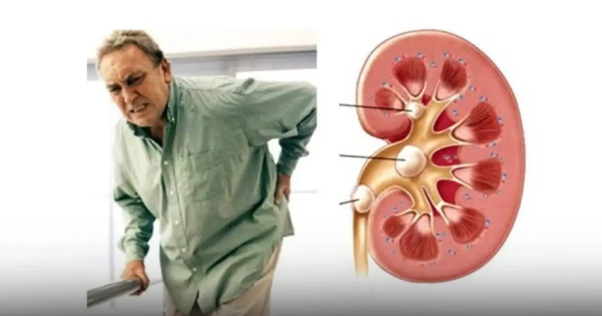 Doctors Warn That Eating Too Much of These Foods May Put Extra Stress on Your Kidneys