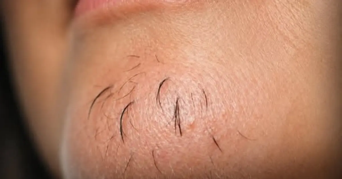 A Woman’s Chin Hair: What It May Reveal About Hormones and Health