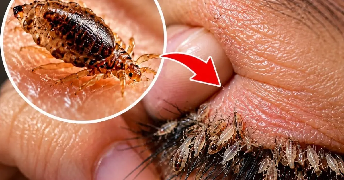 What Can Happen After Sleeping With Someone? Understanding Pubic Lice and Intimate Health