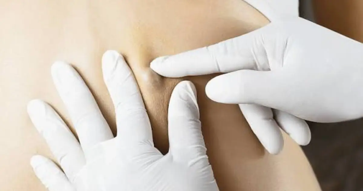 Sebaceous Cysts: What You Should Know About Causes and Home Treatment