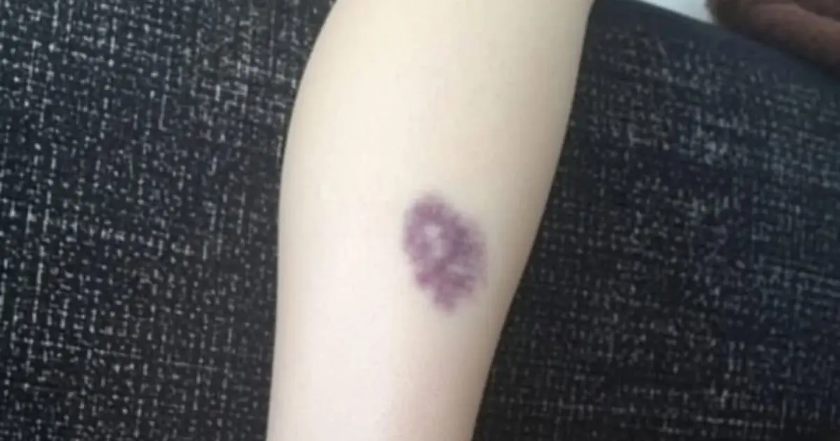 BE CAREFUL, if you get these bruises on your body, it means you have Ca…see more