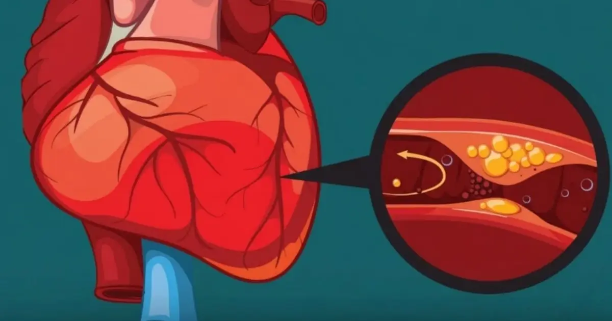 These Foods May Help Reduce Artery Buildup and Support Better Circulation