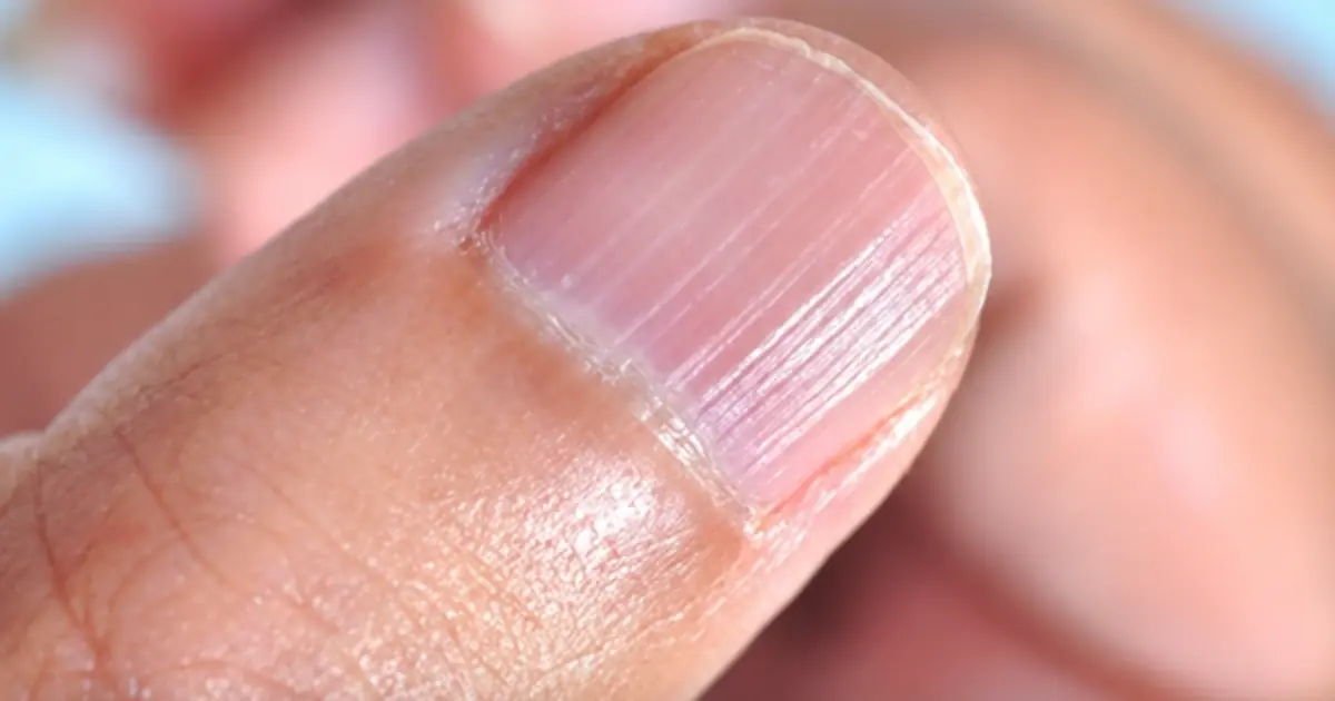 Observe Your Nails to Detect Possible Health Issues: 3 Warning Signs You Should Never Ignore