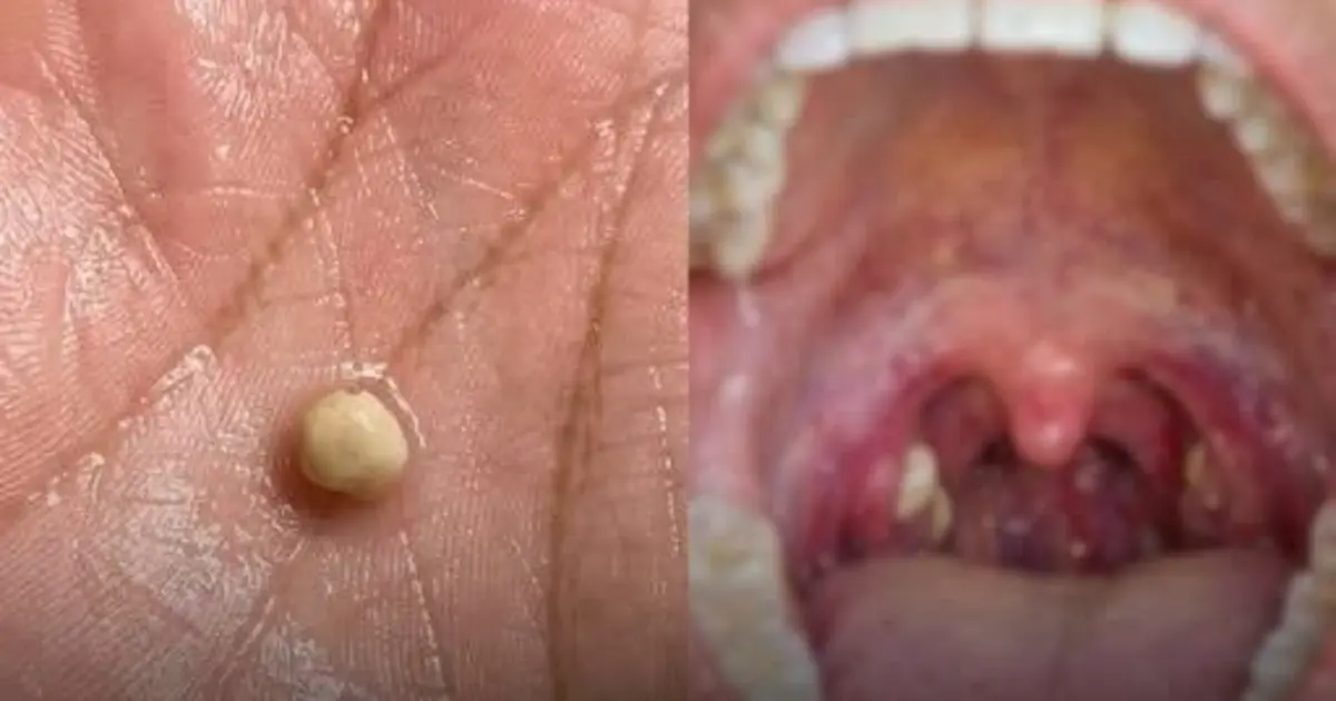 Suddenly Felt Like Something Was Stuck in My Throat… Swallowing Didn’t Help