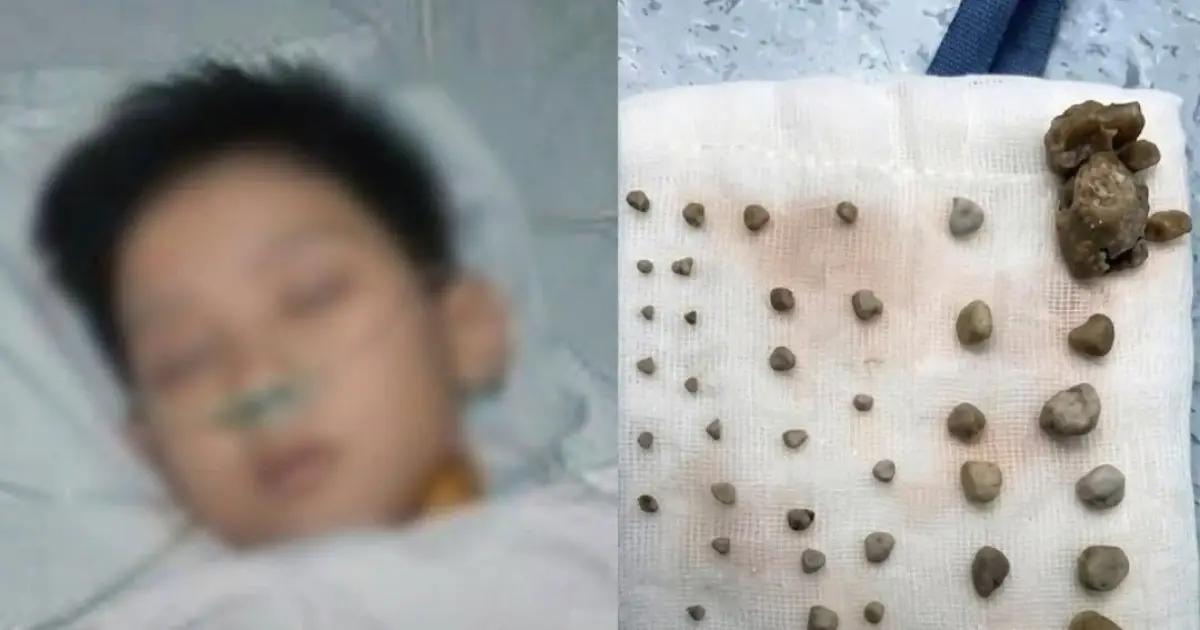 A 9-Year-Old Boy Had 56 Stones in His Abdomen - What His Mother Gave Him Every Day Sh0cked Her