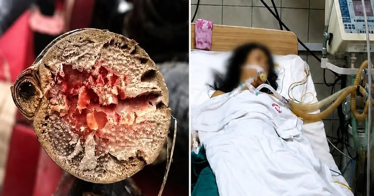 If You Have Colon Polyps, These 4 Symptoms During Bowel Movements Could Be a Warning — See a Doctor Before It's Too Late