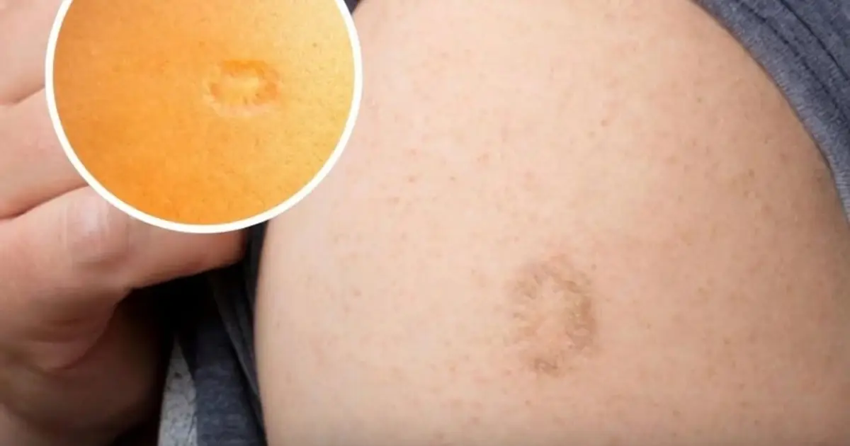 The Real Reason Some People Have a Scar on Their Upper Arm