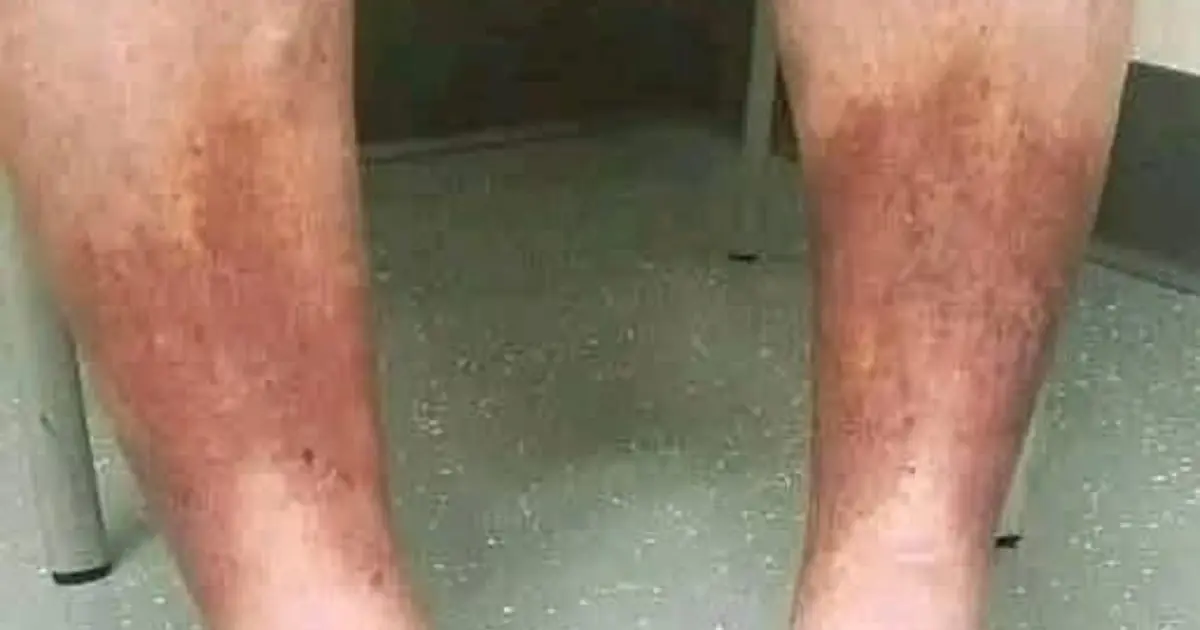 Swollen Feet and Ankles: 10 Possible Causes, Warning Signs, and When to See a Doctor