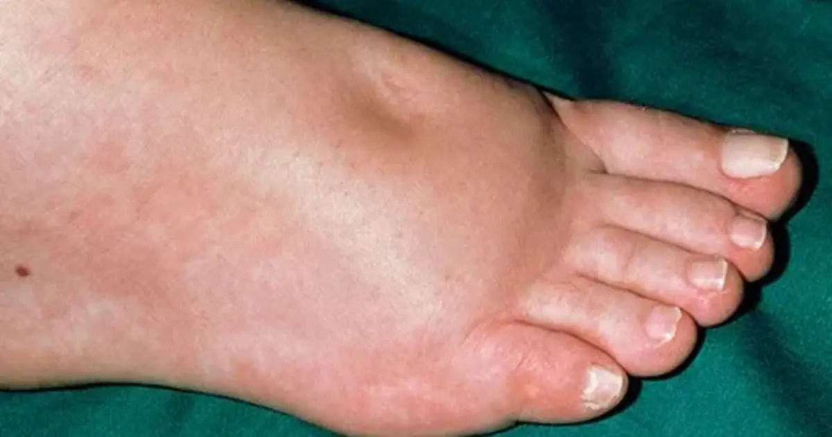 If Your Hands and Feet Keep Swelling, Your Body May Be Sending You a Signal