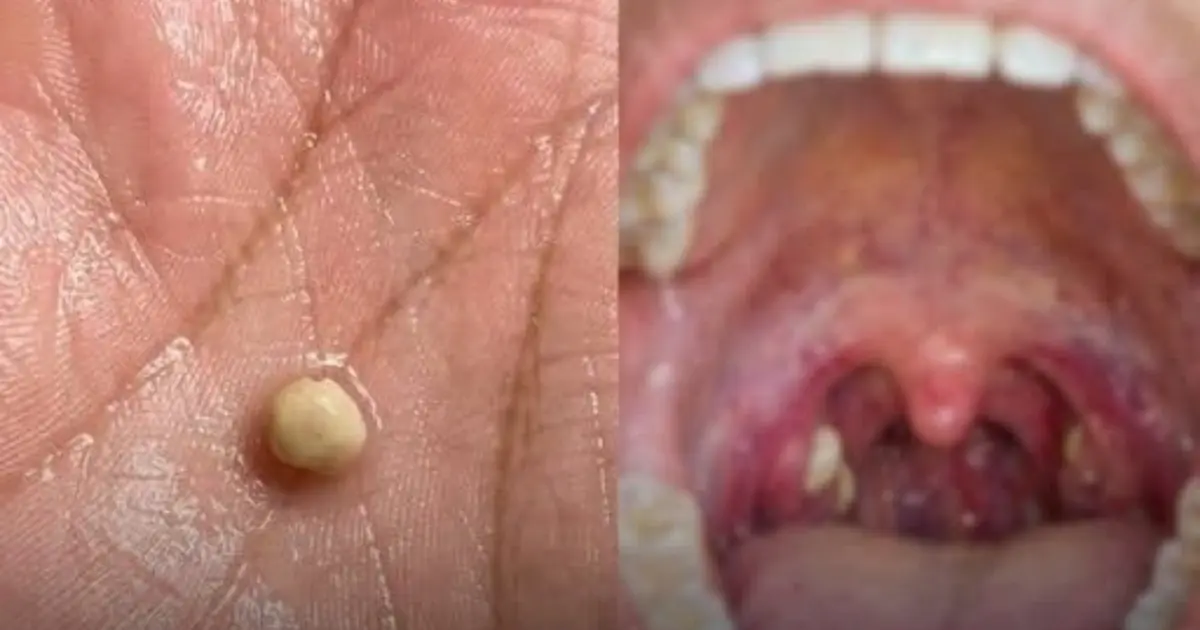 Suddenly Felt Like Something Was Stuck in My Throat… Swallowing Didn’t Help. Then a Strange Lump Came Out. What Was It?