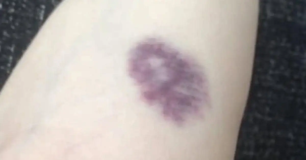 Be Careful: When Unexplained Bruises Could Signal a Serious Health Problem