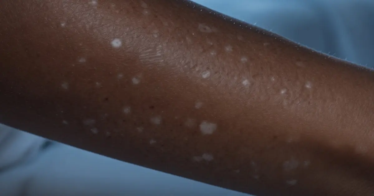 Small White Spots on Your Arms or Legs: What They Could Mean and When to Be Concerned