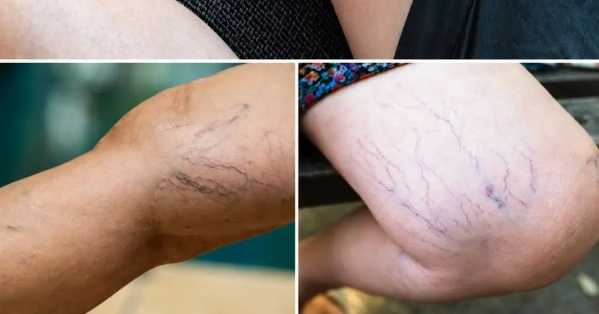 If you have purple veins on your legs, it means you are…