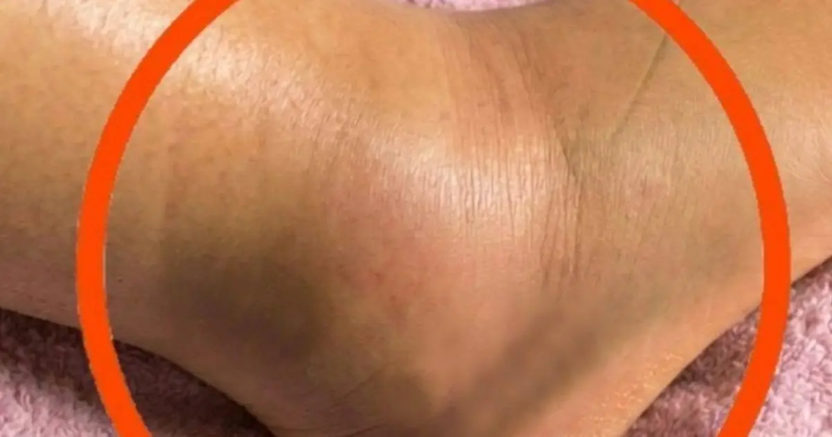 Swollen Legs: When Is It a Warning Sign of a Serious Health Problem?