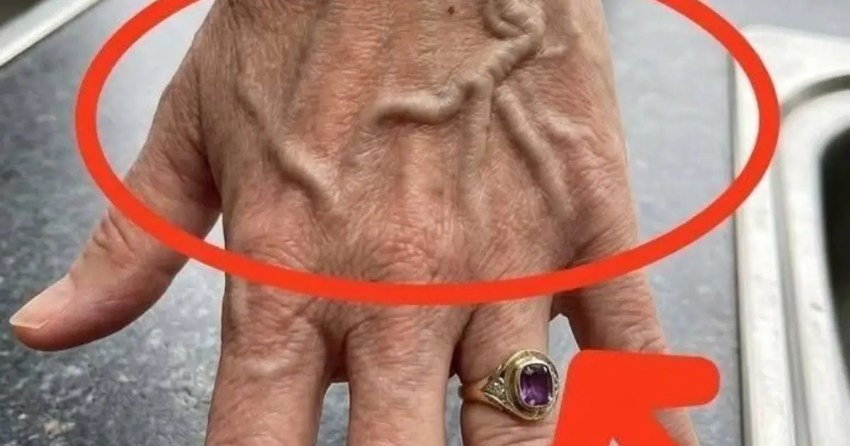 If your veins are visible in your hand, it is a signal of ca…See more