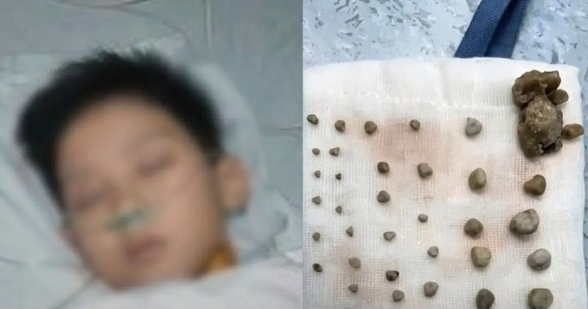 A 9-Year-Old Boy's Mysterious Stones: Why Children's Daily Habits Matter for Kidney and Urinary Health