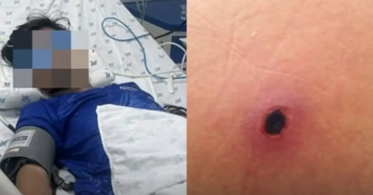 Thought It Was Just the Flu—A 12-Year-Old Boy's Fever Returned, and One Small Mark Changed Everything