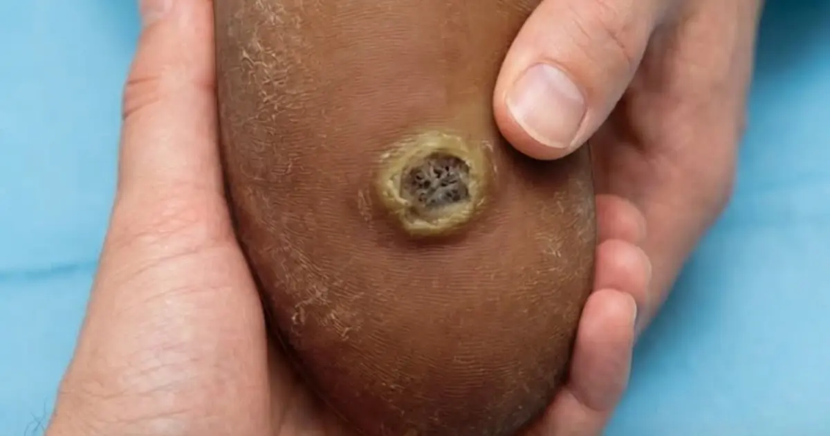 “Fish Eyes” Are NOT Calluses — Here’s the Difference