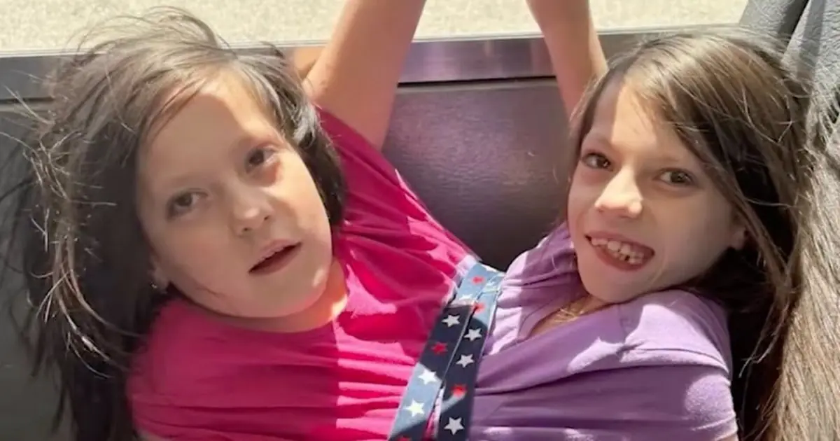 Doctors Gave Her Conjoined Twins Only 24 Hours to Survive - Her Decision Changed Everything