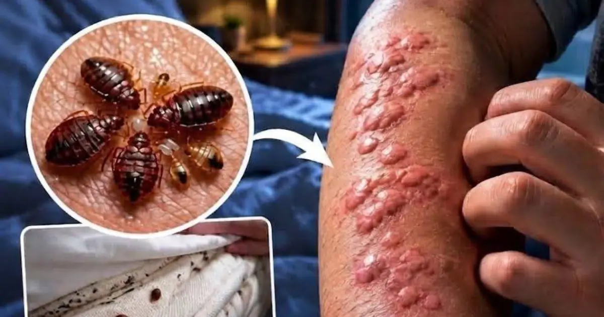 Bed Bugs in Your Bed: The Hidden Health Effects You Should Know About