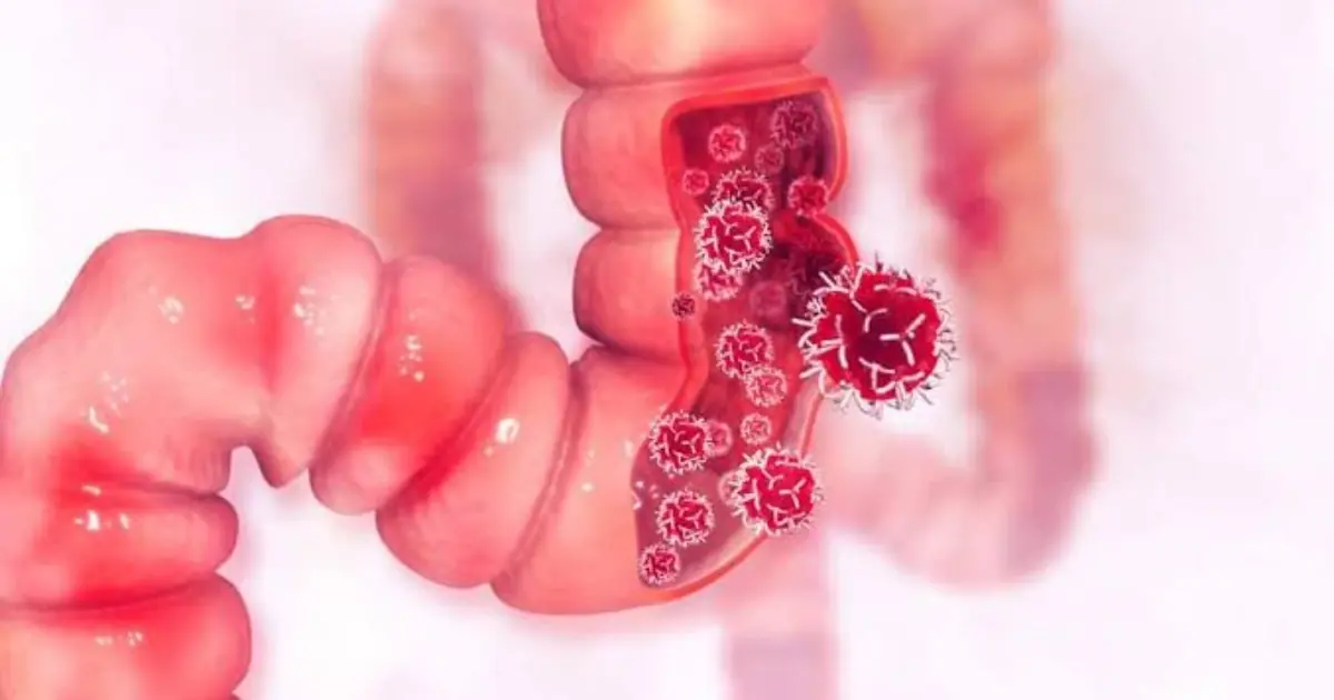 At Just 25, One Warning Sign Led to a Stage 3 Colon Can.cer Diagnosis. Listen At Just 25, One Warning Sign Led to a Stage 3 Colon Can.cer Diagnosis. Listen to Your Body