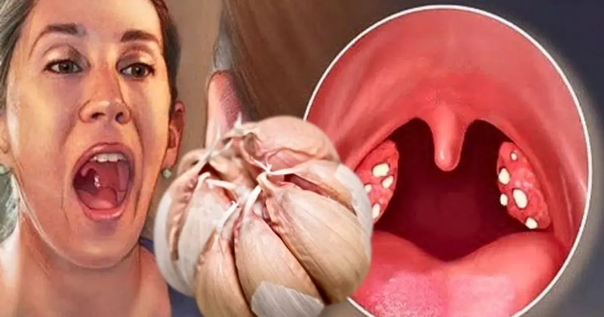 🧄 Garlic Eliminates Infections: Sinusitis, UTIs, Sore Throat & More – 12 Benefits and How to Use It 👇