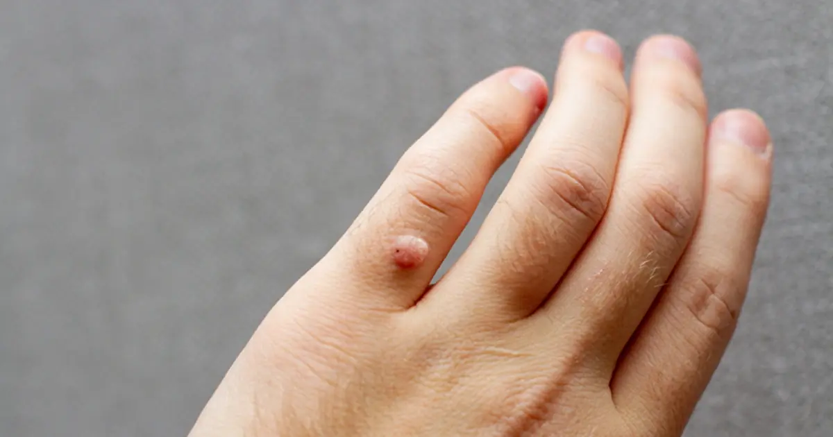 Want to Remove Skin Tags and Warts? Here’s What You Should Know