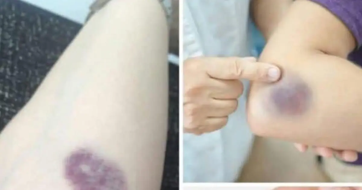Unexplained Bruises on Your Body: What Could They Mean?