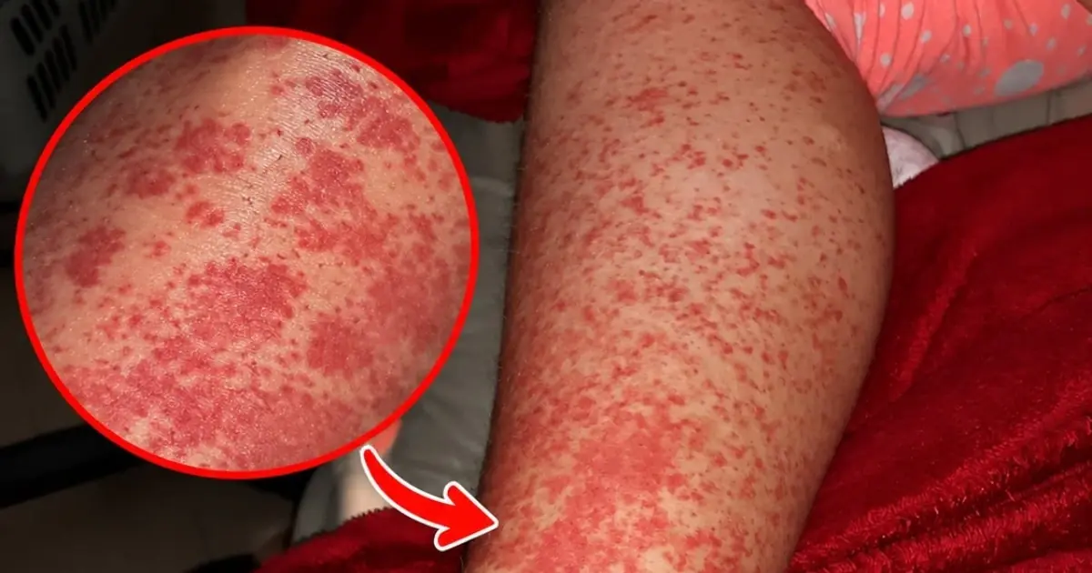 What Can Cause a Rash After Sleeping? Warning Signs You Should Never Ignore