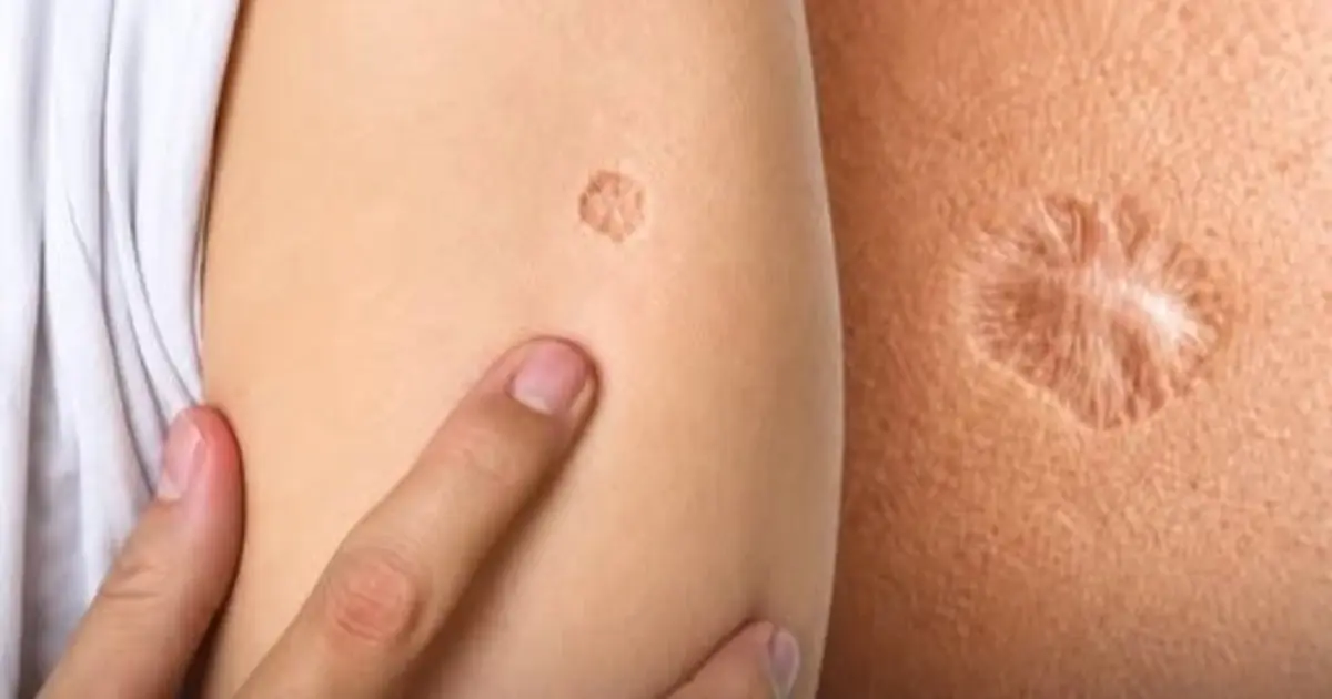 Why Do So Many People Have the Same Small Scar? The Mystery Behind a Global Mark