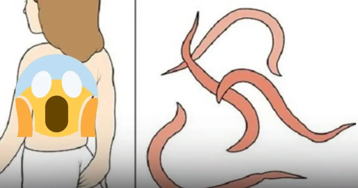 Pinworms: the night-active parasite that bothers children