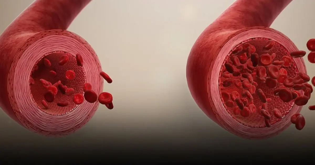 Researchers Warn That Genetics, Including Blood Type, May Affect Stomach Can.cer Risk